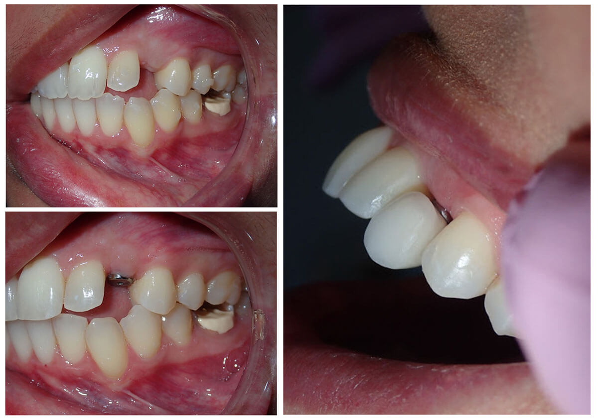 dental-implant-collage