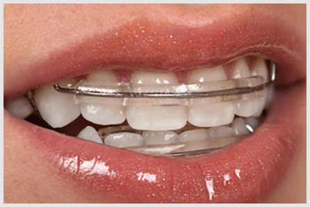 Inman Aligners