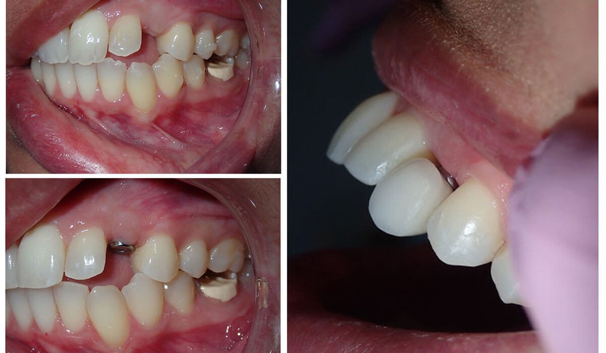 dental-implant-collage